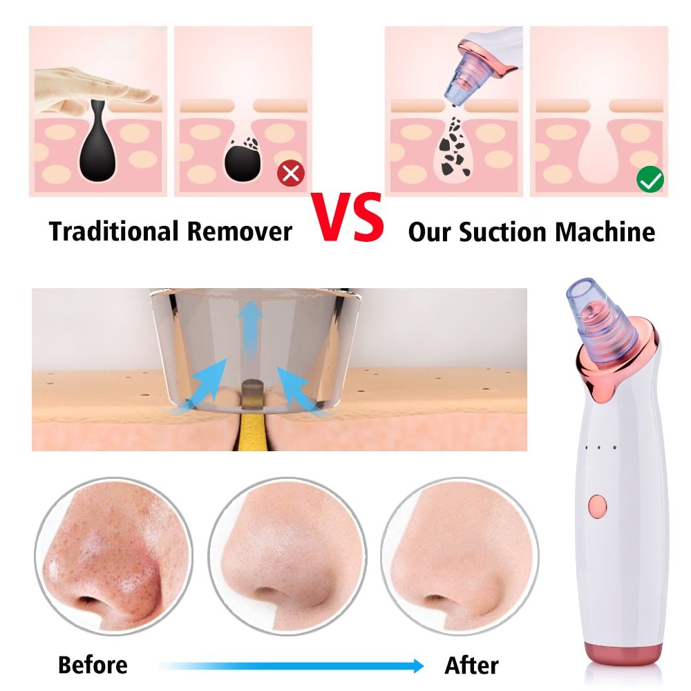 Electric Blackhead Suction Instrumen