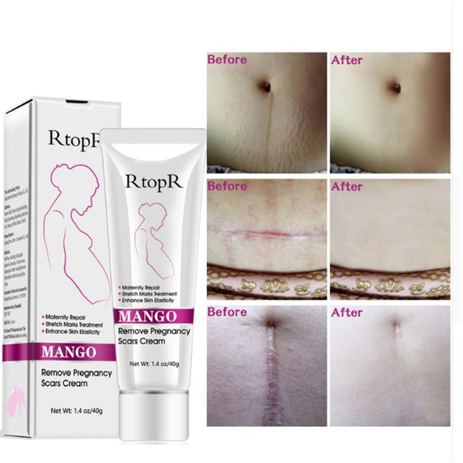 Natural Mild Non-irritating Mango Remove Stretch Mark Cream For Pregnancy Repair